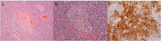 Pathologic examination based on hematoxylin and eosin staining shows the following: (a) microvascular proliferation and angio-sclerosis, (b) atrophy of the germinal center, (c) FDC with CD21-positive proliferative lesion.