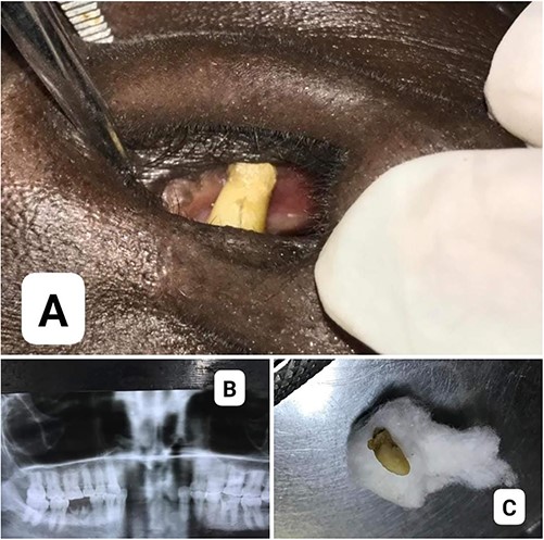 (A) Tooth-like structure protruding from the nasal septum; (B) radiographic appearance of a tooth-like structure in the right nasal cavity; (C) the supernumerary tooth after surgical removal.