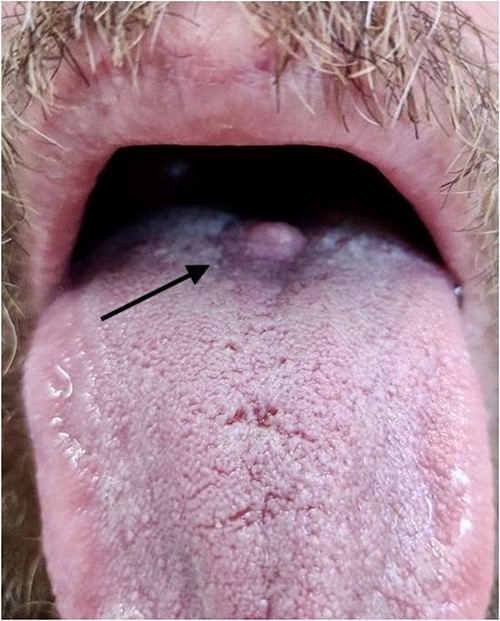 Photograph of lesion pre-operatively, arrow indicates position of lesion at the junction of the anterior two-thirds and posterior one-third of the dorsum of the tongue.
