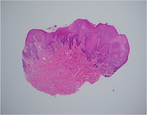 Haematoxylin and eosin stain, 40× magnification, showing reactive epithelial hyperplasia on the surface, this can be mistaken for squamous cell carcinoma in a superficial biopsy.