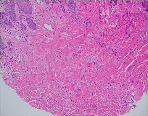Haematoxylin and eosin stain, 100× magnification, showing tumour cells in stroma that may not be sampled by a superficial biopsy.