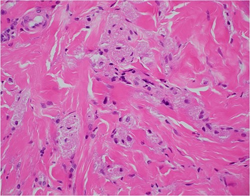 Haematoxylin and eosin stain, 400× magnification, showing tumour cell features of nests of epithelioid cells in the stroma with indistinct borders and granular pale eosinophilic cytoplasm.