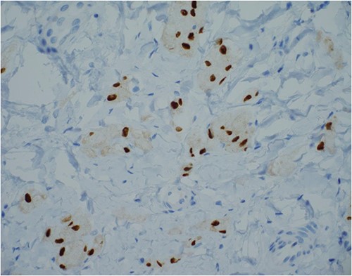 SOX-10 immunostain, 400× magnification—an alternative to S100 immunostain.