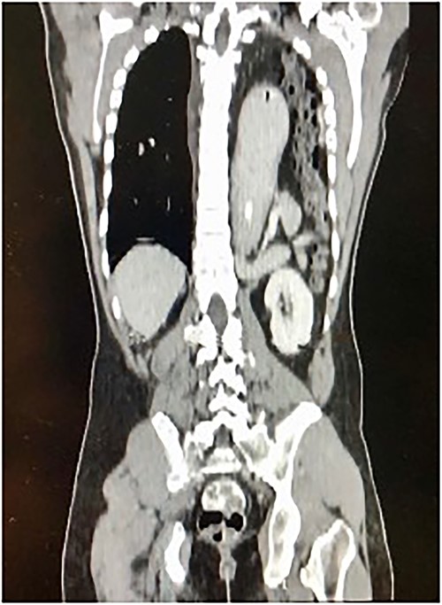 Longitudinal thoraco-abdominal CT scan shows protrusion of stomach, small and large bowel through a left posterolateral hemi-diaphragmatic defect.