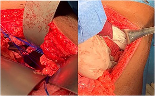 Left Photograph showing a posterolateral defect at the left hemi-diaphragm. Right Photograph showing defect repaired using composite mesh.