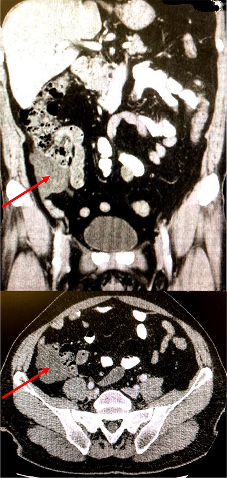 Coronal and axial CT images of lesion