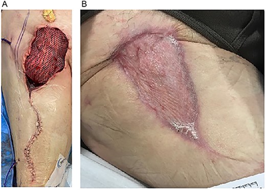(A) Inset of right RFF-STSG over right groin defect. (B) Four months postoperative. Well-healed RFF-STSG over right groin.