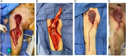 (A) Right groin defect and rectus femoris muscle. (B) Right groin defect with RFF elevated proximally to demonstrate adequate groin coverage. (C) Right groin reconstruction with RFF with STSG. (D) Two weeks postoperative; RFF-STSG.