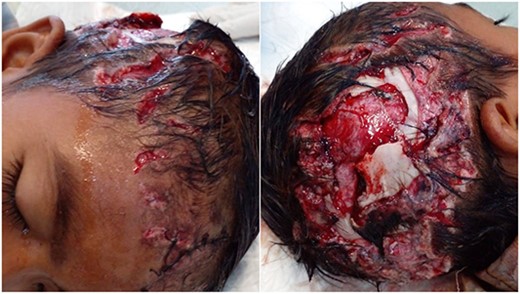 Initial physical examination showed scalp defect, exposed and depressed fractured bone, some bone loss, visible dura layer and necrotic tissue.