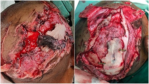 Pre- and post-debridement, removal of dirty nonviable tissue and decompression of depressed fracture. Some mini plates held the bone fragments securely.