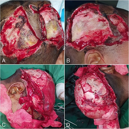 Preoperative condition (A, B) and flap elevation (C, D).