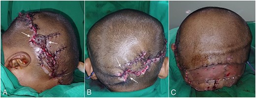 Picture of the post flap (A, B) and skin graft procedure (C). The white arrow showed the necrotic tissue which developed later after the surgery.