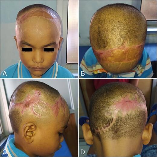 Clinical photos 10 weeks postoperatively: frontal view (A), superior view (B), right lateral view (C) and posterior view (D).