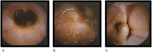 Capsule endoscopy: tight stricture noted within the ileum (A) with multiple areas of ulceration (B) and an area with apparent false lumen (C).