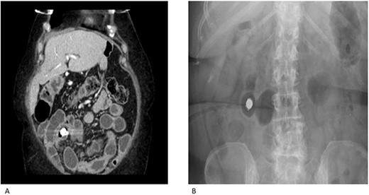CT enterography (A) and plain X-ray (B) demonstrating multiple areas of mid small bowel stricturing. Some evidence of deep ulceration and skip lesions. Of note, the capsule remains stuck within the small bowel and is at risk of causing obstruction.
