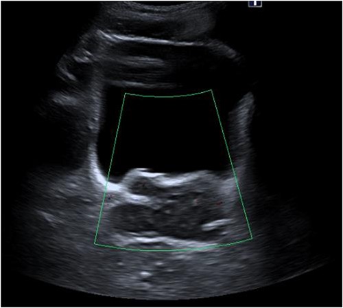 Renal ultrasound showing enlarged prostate indenting into the bladder.