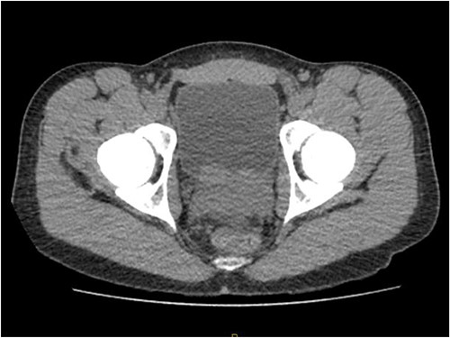 CT KUB showing irregularly enlarged prostate.