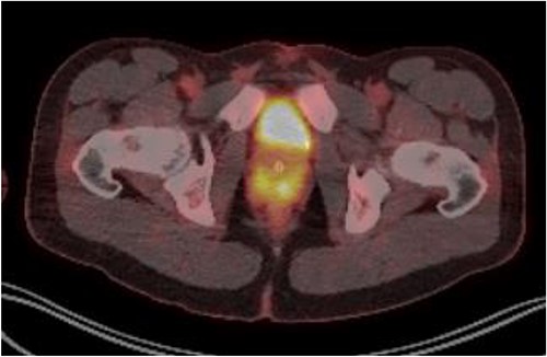 PET FDG scan pre-R-CHOP chemotherapy showing disease activity in the prostate.