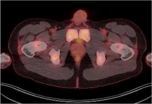 PET FDG scan post R-CHOP chemotherapy showing prostate with complete resolution from the disease.