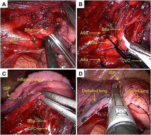 Open insufflation method for left segmentectomy 8a + 9a. (A) Dissection of the subsegmental bronchus (left B8a). (B) Insertion of a central venous catheter at the distal end of the subsegmental bronchus (left B8a). (C) Introduction of an appropriate amount of air into the target subsegment (left S8a) via a 50-ml syringe. (D) Resection of the target lung (inflated) along the intersegmental plane using a stapler.
