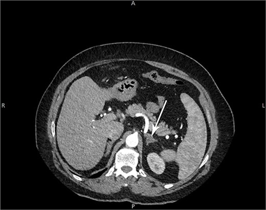 Arrow: a 1.5 cm non-enhancing hypodense nodule of the left suprarenal gland on CT imaging.