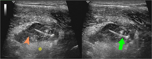 Ultrasound images showed a large pus-filled (arrowhead) appendix with a thin internal echogenic structure (arrow) extending outward from the muscle layer with surrounding fat infiltration (asterisk).