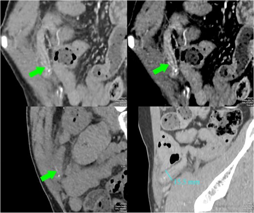 CT images showed a dilated appendix (maximum diameter 15.5 mm) with thickened and hyperenhancing wall. A small amount of free fluid and fat stranding was seen in the right iliac fossa. There was a linear hyperdensity measuring 13 mm (arrows) perforating and extending slightly beyond the appendix. No abscess or free gas collection was detected.