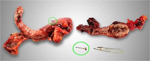 Photograph of the surgical specimen showed appendicitis due to fish bone (circles).