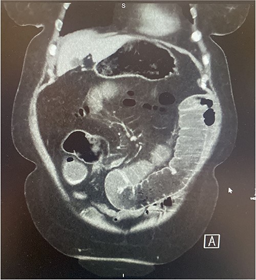 Coronal section of contrast CT AP demonstrating small bowel intussusception with proximal dilation and associated filling defect.