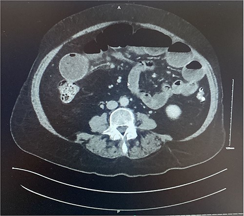 Axial section of contrast enhanced CT AP demonstrating intussusception with surrounding lymphadenopathy.