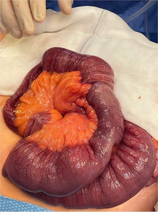 Intraoperative identification of intussusception located 1 m from the ileocecal valve.