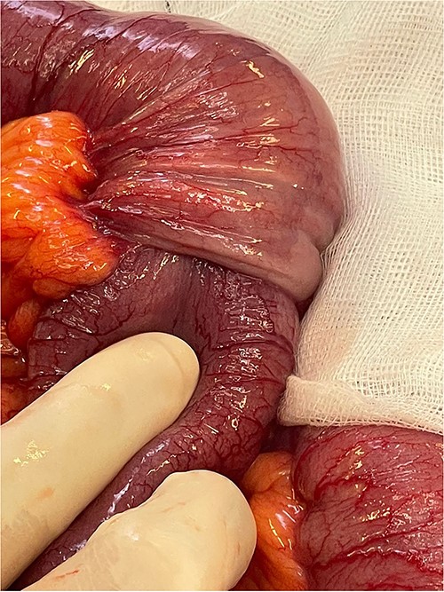 Focus of intussusception with proximal dilation and hypertrophy.