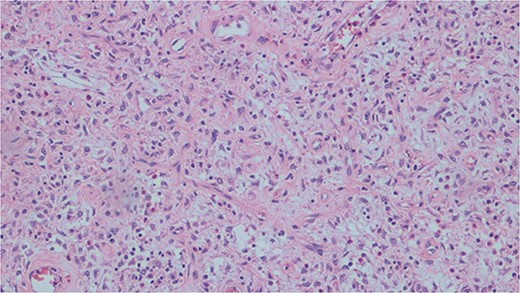 Histopathological slide demonstrating bland mesenchymal cells with a rich eosinophilic infiltrate.