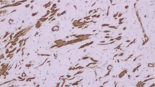 IFP cells staining positive for Vimentin.