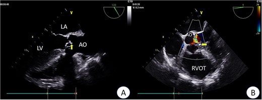 Preoperative TEE: Aortic valve leaflets, calcification, and regurgitation observed in the short-axis section of preoperative TEE. Key abbreviations: LA - left atrium; LV - left ventricle; AO - aorta; RVOT - right ventricular outflow tract.