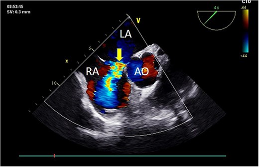 Preoperative TEE: Short-axis view reveals left-to-right atrial septal shunt with a 9 mm blood flow beam (indicated by arrow). Abbreviations: LA - left atrium; LV - left ventricle; AO - aorta.