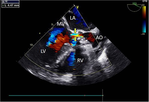 Intraoperative TEE: Long-axis aortic view displays a 4.5 mm-wide perivalvular blood flow bundle around the aortic valve (arrow). Abbreviations: LA - left atrium; LV - left ventricle; RV - right ventricle; AO - aortic.