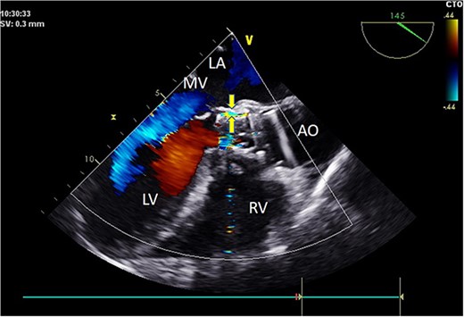 Intraoperative TEE: Long-axis aorta section shows a 1.5 mm-wide paravalvular blood flow beam, demonstrating significant improvement. Abbreviations: LA - left atrium; LV - left ventricle; RV - right ventricle; AO - aorta; MV - mitral valve.