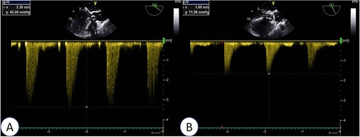 Intraoperative TEE: Post-release of self-expanding valve, aortic valve’s maximum flow velocity measures 166 cm/s, with a pressure difference of 11 mmHg (B), a significant improvement compared to pre-surgery (A: maximum flow velocity of 336 cm/s, pressure difference of 45 mmHg).