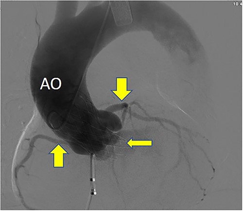 Postoperative DSA: Self-expanding valve holder’s shape and position (thin arrow) are normal, while left and right coronary artery openings (thick arrow) are unobstructed with clear blood flow.