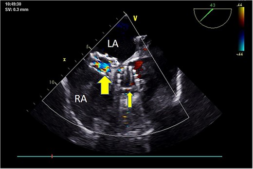 Postoperative TEE: Short-axis TEE displays circular echoes in the self-expanding valve (thick arrow) with good morphology and position. The sealing umbrella (thin arrow) maintains a proper shape and fixed position, eliminating left-to-right atrial-level shunt.