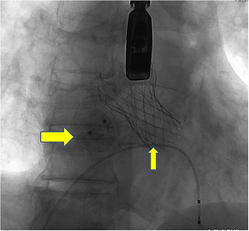 Postoperative DSA: Digital subtraction angiography confirms the proper positioning of the aortic self-expanding valve (thin arrow) and occluder (thick arrow).
