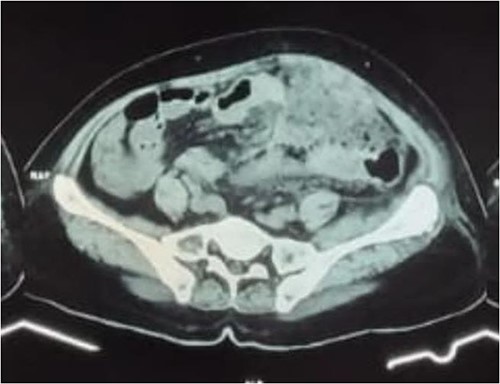 Abdominal CT scan with contrast showed transverse, descending to sigmoid colon wall thickening and significant contrast enhancement supporting colitis with mesenteritis.