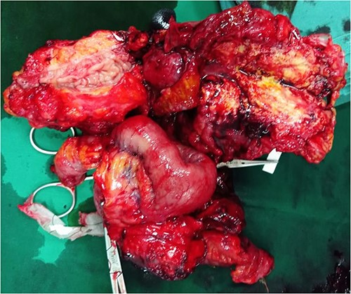 Intraoperative exploratory laparotomy situs: dense adhesional mass involving the sigmoid colon, surrounding ileum, and anterior peritoneum in the left lower quadrant mimicking advanced stage neoplasm (pseudotumor).