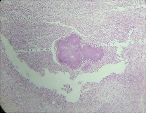 Sulfur granules appearance revealed from histopathological examination of sigmoid colon tissue which indicate actinomycose infection.