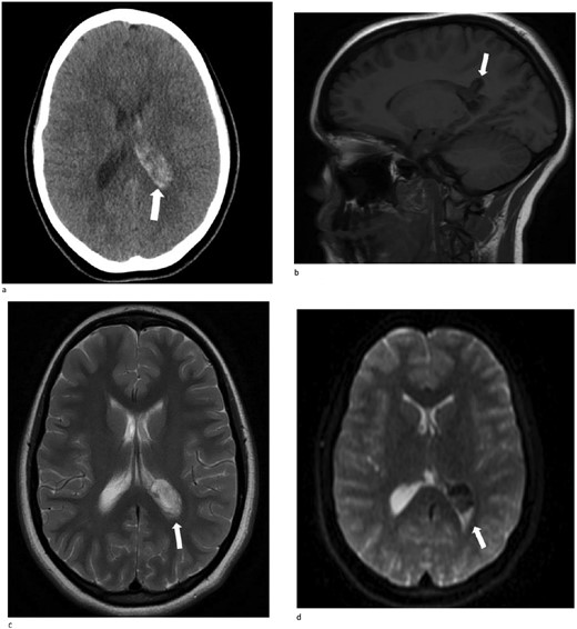 (a)–(d) Demonstrates evidence of a hemorrhagic lesion involving the left atrium and adjacent periventricular deep white matter with a moderate amount of intraventricular hemorrhage within the left ventricle.