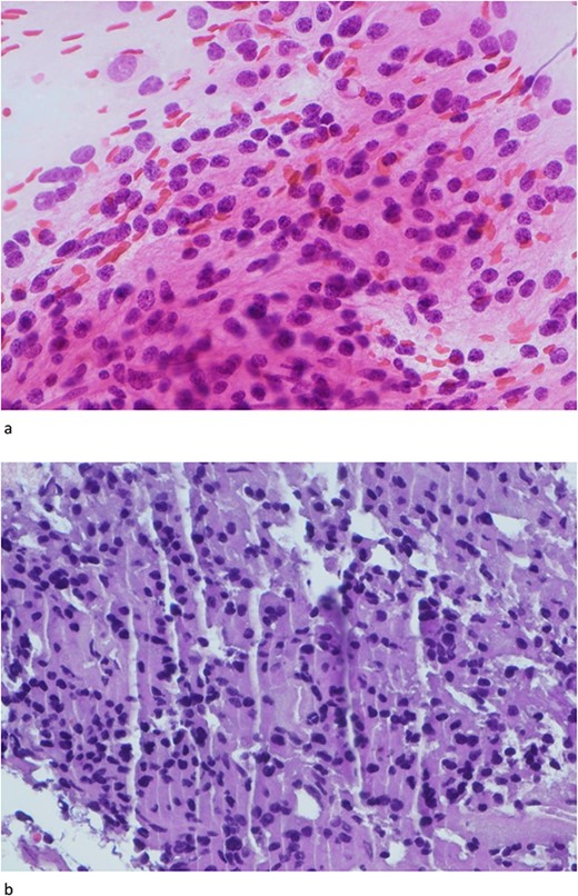(a) and (b) The touch preparation and frozen section control shows similar histologic features. The cystic lesion shows a moderately hypercellular tumor, with uniform round nuclei, irregular distribution of chromatin, and a moderate amount of eosinophilic cytoplasm. There is no distinct fibrillary background (Hematoxylin and eosin, 400×).