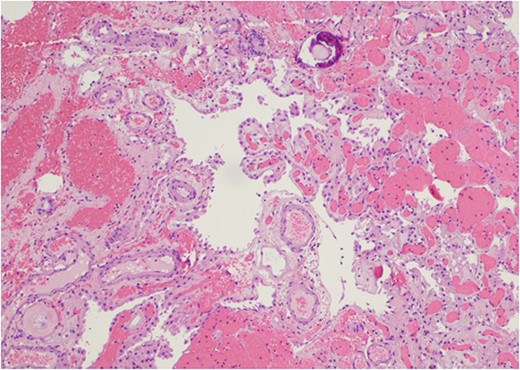 The intraventricular tumor consisted cuboidal epithelium overlying vascularized papillae. The nuclei are uniform without atypia. A psammomatous calcification is present in the upper portion of the field (Hematoxylin and eosin, 100×).