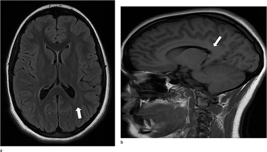 (a) and (b) Stable postsurgical findings compatible with gross total resection of left atrial and adjacent periatrial tumor. No MRI evidence of residual/recurrent mass, with normal ventricular size.