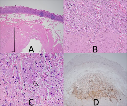 (A) GCT in deep submucosa with overlying gastric mucosa and adjacent chronic gastritis (tumor in bracket), 20× magnification. (B) Tumor cells abutting muscularis propria, 100× magnification. (C) Pustule-ovoid body of Milian (arrow), 400× magnification. (D) S-100 IHC stain highlights tumor cells, 20× magnification.